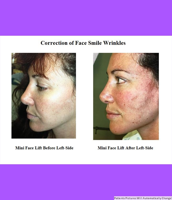 Correction of Face Smile Wrinkles, Mini-Facelift,  Left Side View $3,200.00