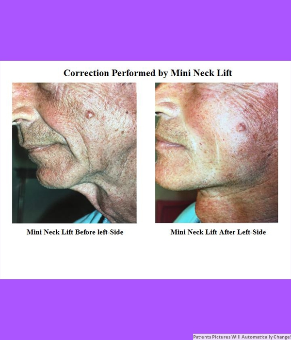 Correction Performed By Mini-Neck Lift, Left Side View Cost is $3200.00