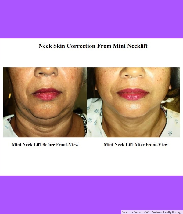 Neck Skin Correction From Mini Neck Lift, Front View Cost is $3,200.00