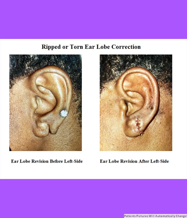 Ripped or Torn Ear Lobe Correction, Left Side View Cost is $400.00 Per Side!